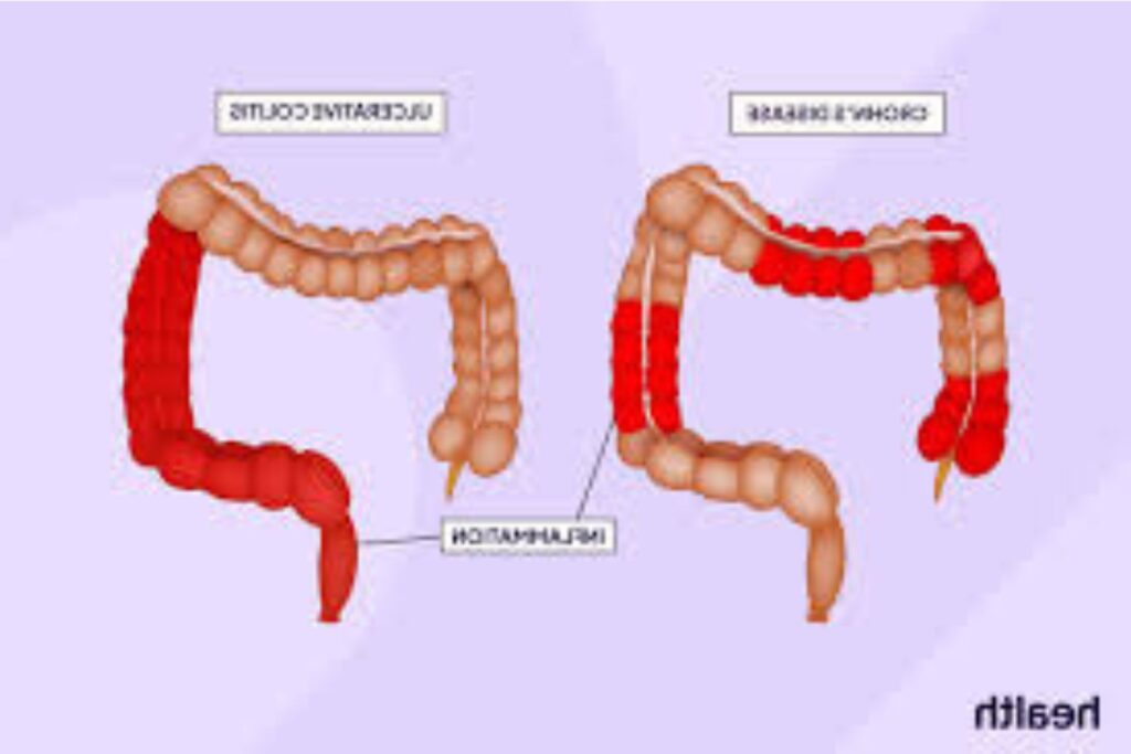 Crohns Disease